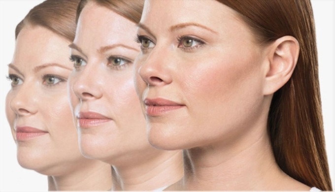Belkyra-dubbelhaka-behandling-Forever-Beauty-Klinik-Academy
