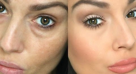 MorkaRingarOchPasarUnderOgonen-Forever-Beauty-Klinik-Academy
